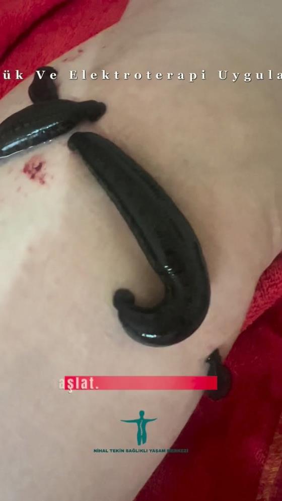 Sülük Ve Elektroterapi Uygulama